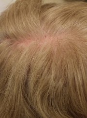PRP Hair 2 - Before Treatment